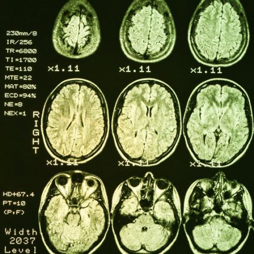 Earlier Diagnosis and Treatment of Dementia in Parkinson's